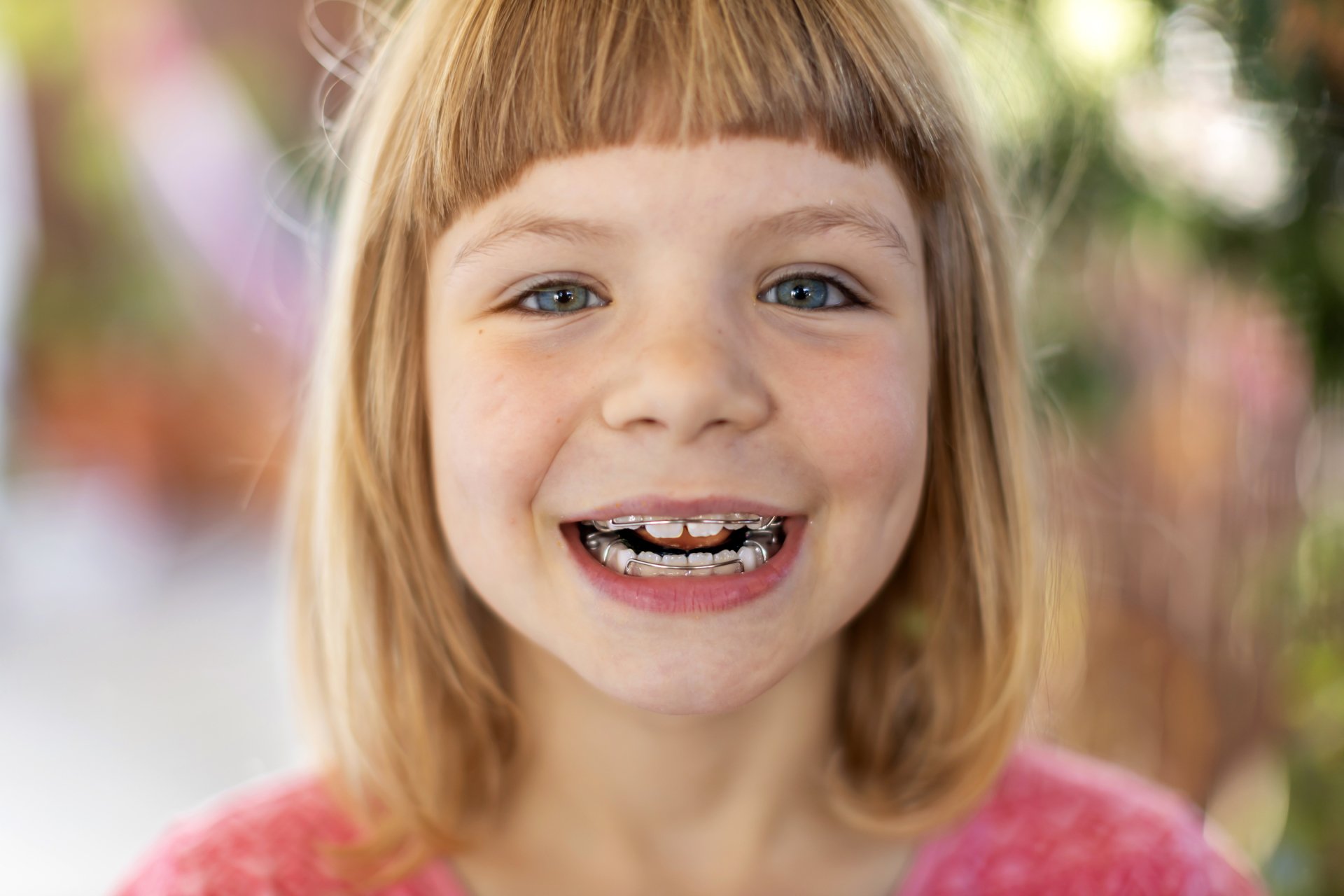 51 Zahnspange Für Kinder Kostenlos | Kinder